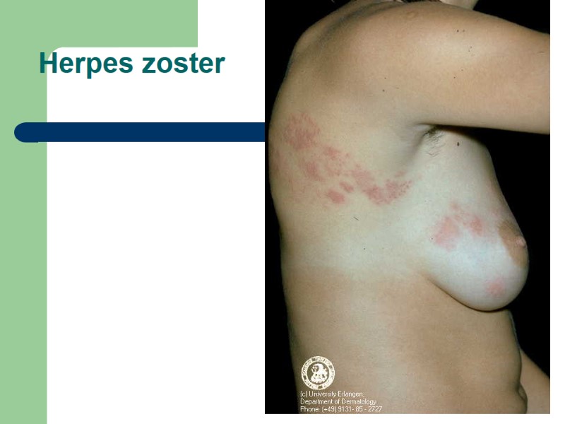 Herpes zoster